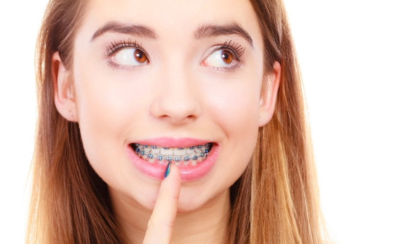How long does it take to wear Braces? Hình: How long does it take to wear Braces?