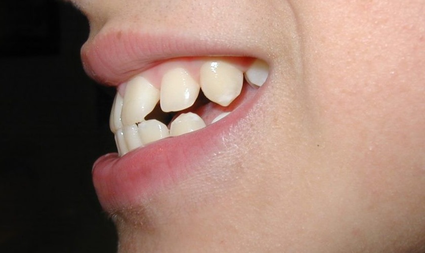 Protrusion braces treatment with modern technology Hình: Protrusion braces treatment with modern technology