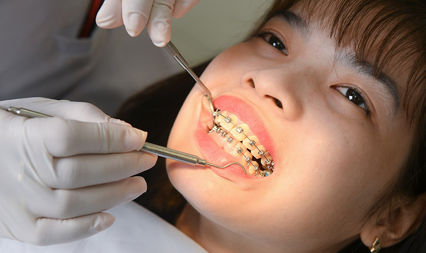 The recommended Braces cases Hình: The recommended Braces cases
