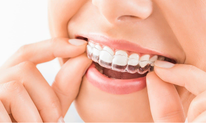 The secrets of invisible braces! Hình: The secrets of invisible braces!