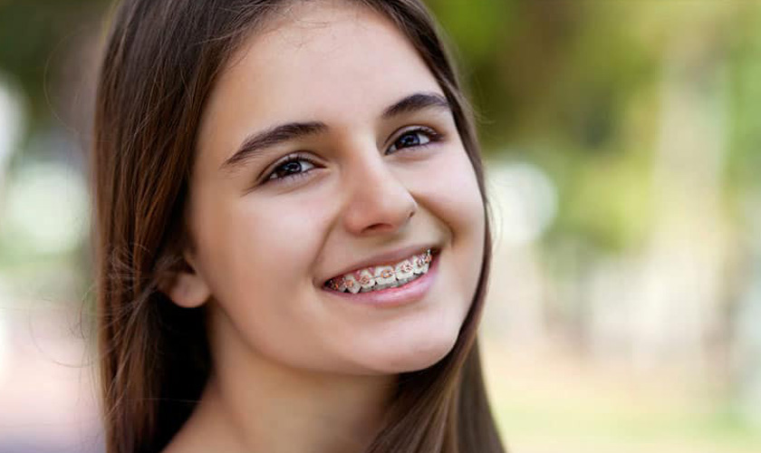 Types of braces today Hình: Types of braces today