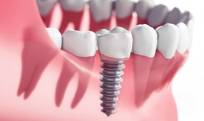 A New Technique in Alveolar Cleft Bone Grafting for Dental Implant Placement in Patients With Cleft Lip and Palate Hình: A New Technique in Alveolar Cleft Bone Grafting for Dental Implant Placement in Patients With Cleft Lip and Palate
