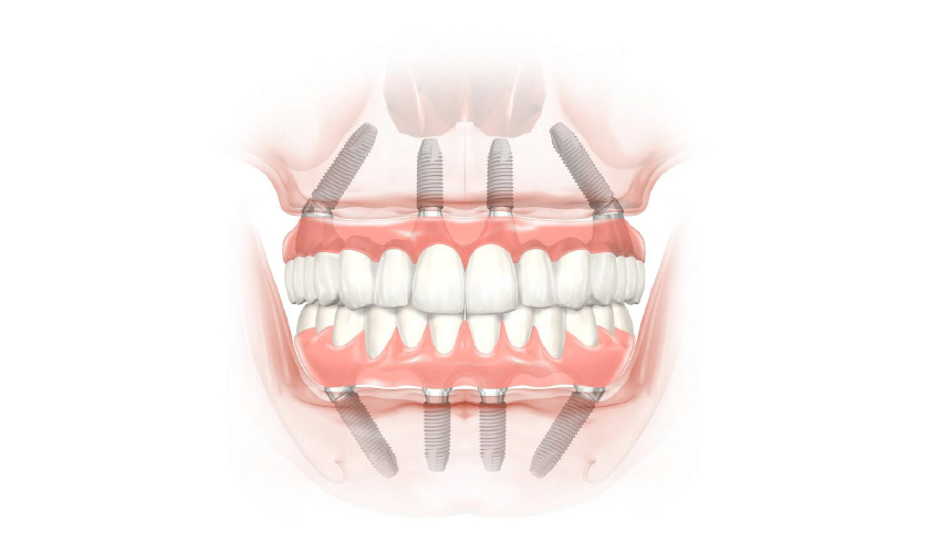 All on 4 implant - The golden choice for teeth loss patients Hình: All on 4 implant - The golden choice for teeth loss patients