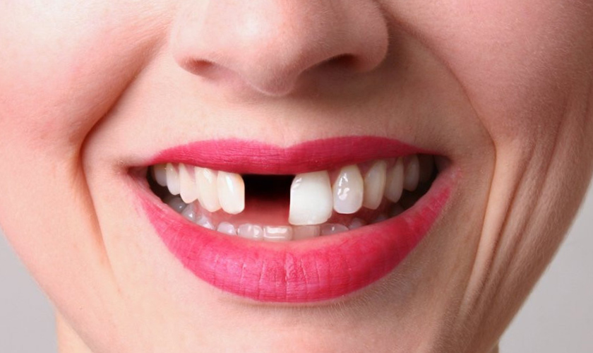 Bridgework or dental implant what is better for one missing teeth? Hình: Bridgework or dental implant what is better for one missing teeth?