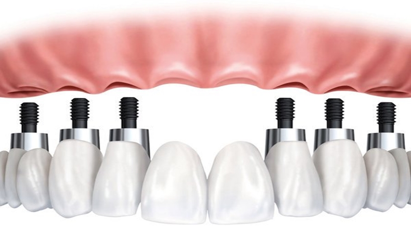 Dental Implant and problems to be avoided Hình: Dental Implant and problems to be avoided