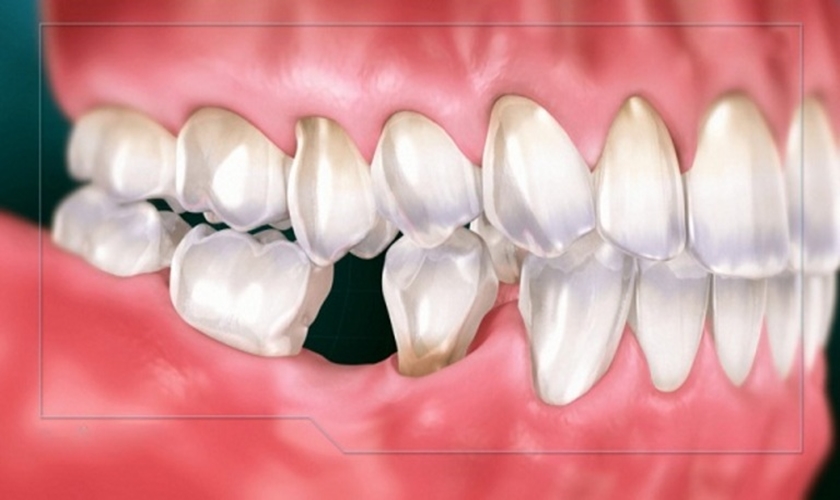 How much does a lower jaw implant cost? Hình: How much does a lower jaw implant cost?
