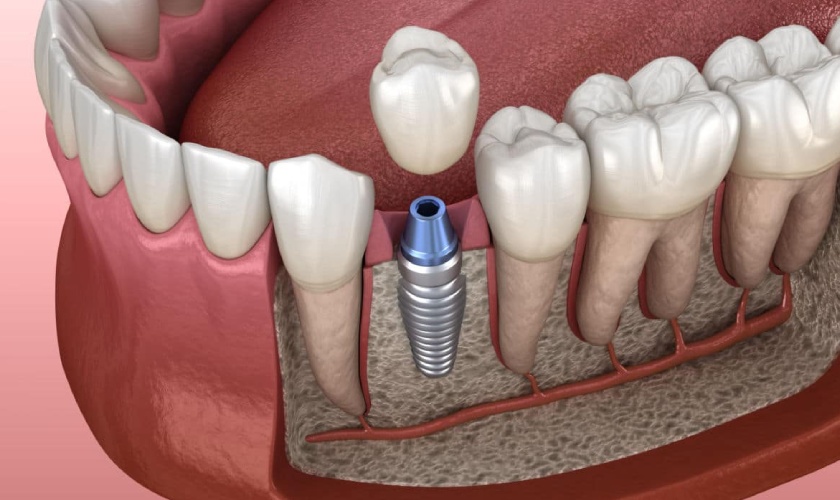 How much is a dental implant? Is it safe? Hình: How much is a dental implant? Is it safe?