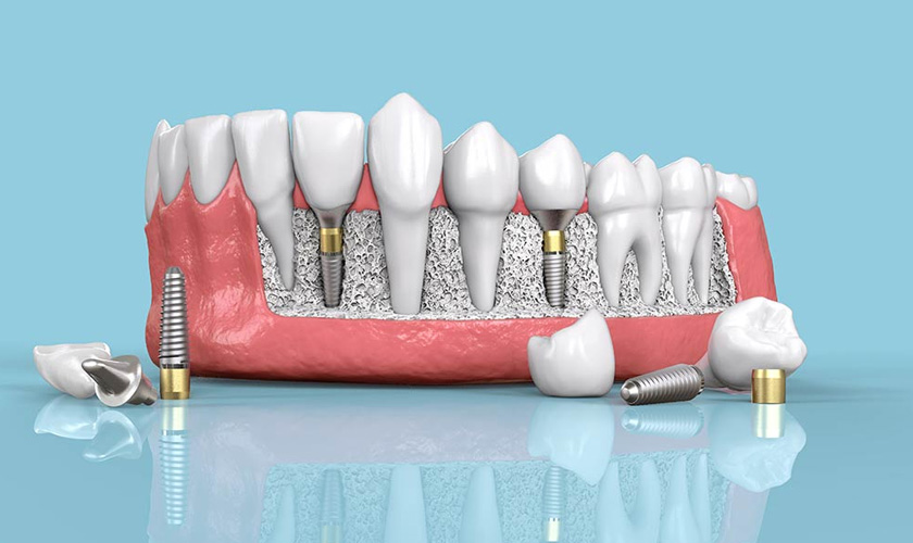 Why should you have dental implants? Hình: Why should you have dental implants?