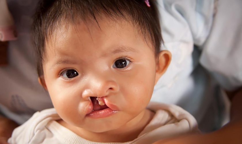 Caring for pediatric patients after cleft lip-palate surgery Hình: Caring for pediatric patients after cleft lip-palate surgery