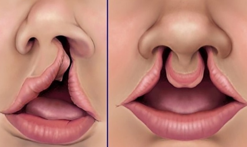 Cleft lip and cleft palate - Things you need to know! Hình: Cleft lip and cleft palate - Things you need to know!