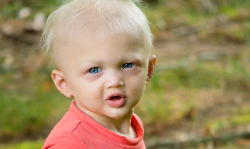 Ectodermal dysplasia syndrome Hình: Ectodermal dysplasia syndrome