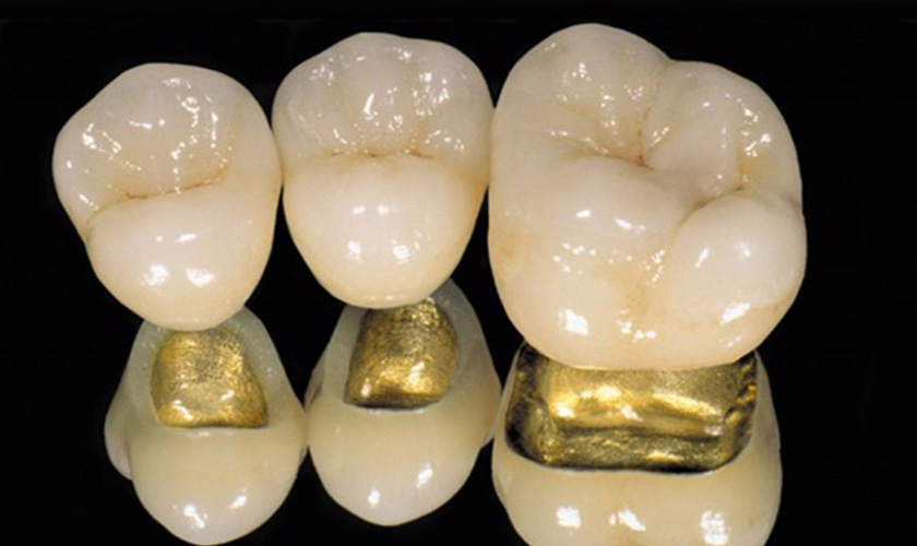 What is a precious metal crown? Hình: What is a precious metal crown?