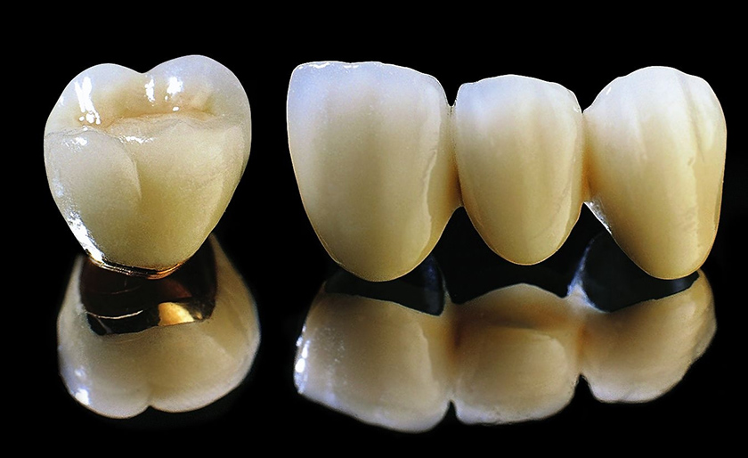 What is Titanium dental crowns? Hình: What is Titanium dental crowns?